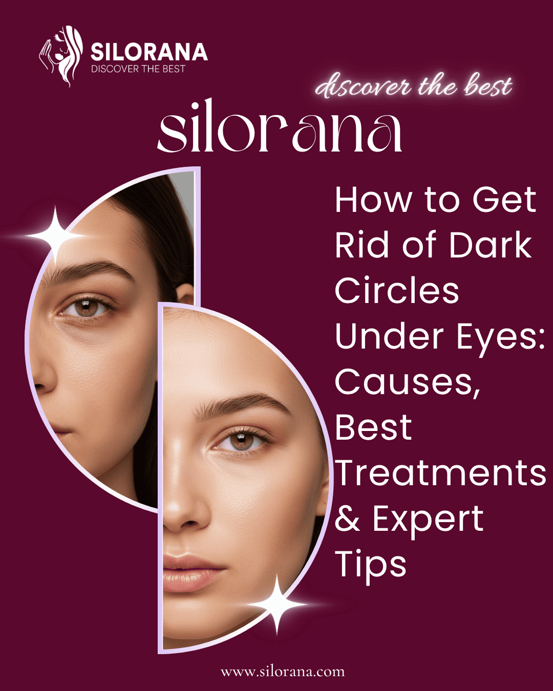 How to Get Rid of Dark Circles Under Eyes: Causes, Best Treatments & Expert Tips